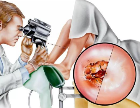  宫颈白斑与宫颈上皮异位：了解病因与危害