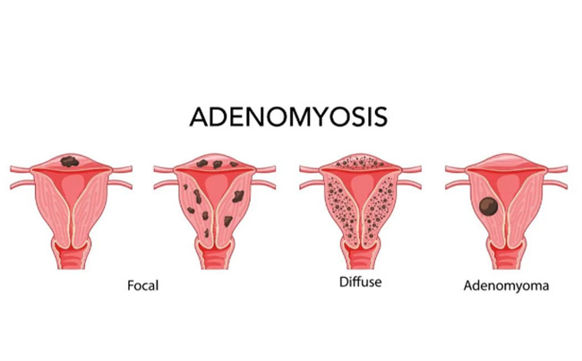 解密子宫腺肌症：治疗方法一览