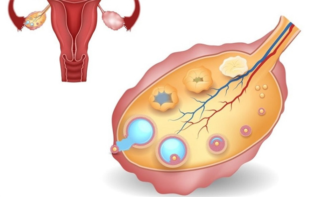 女性不排卵的症状解析：关注月经健康，科学备孕